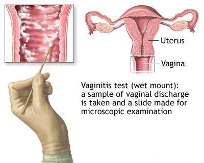recoltare secretie vaginala