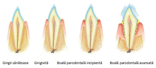 boala parodontala