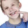 La ce varsta este indicat aparatul dentar la copii