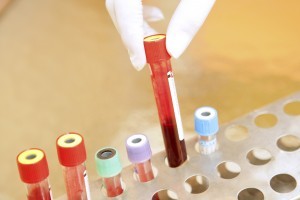 Investigatii medicale necesare in descoperirea la timp a cancerului sau a virusului HIV